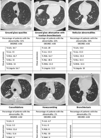 Hình chụp X-quang của bệnh nhân sau một năm khỏi Covid-19 xuất hiện các bất thường trên phổi. Ảnh: Respiratory Research.