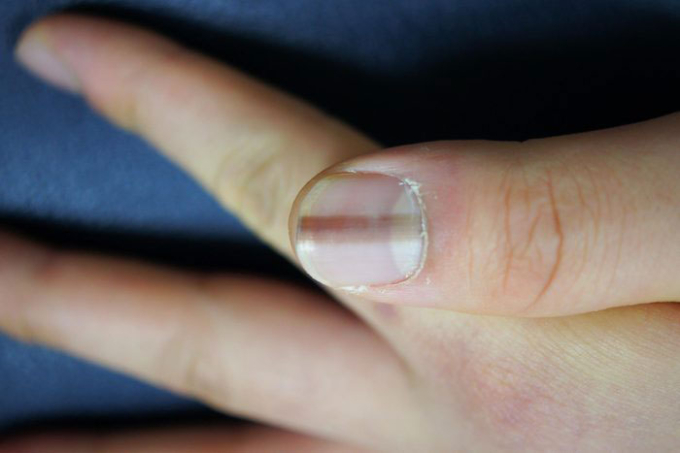 Dấu hiệu bất thường trên móng tay có thể cảnh báo ung thư da hiếm gặp