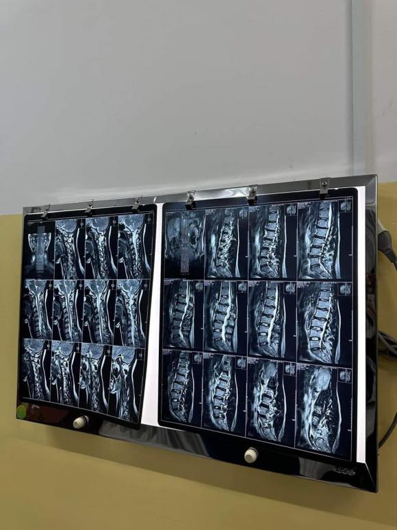   Minh Tú tiết lộ bản thân đang đối mặt với các vấn đề liên quan đến cột sống, thoái hóa và mất xương  