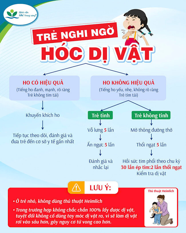 Các chuyên gia y tế hướng dẫn chi tiết cách thức xử lý khi trẻ bị hóc dị vật.