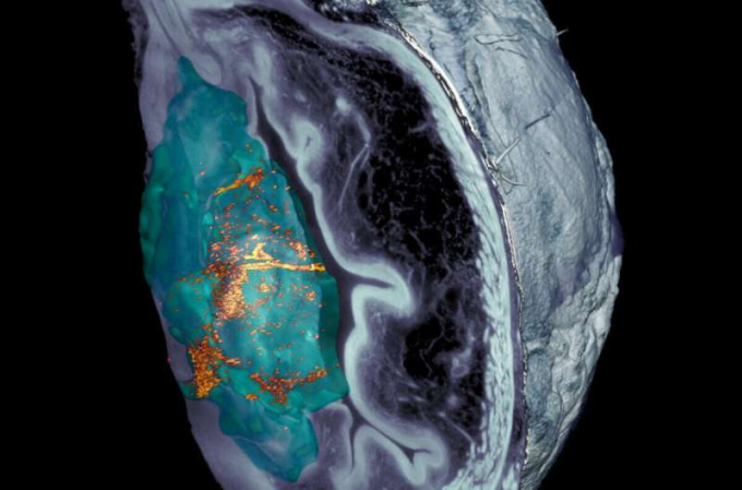 Sự tích tụ của nanorobot trong khối u dưới kính hiển vi. Nguồn ảnh: IRB Barcelona