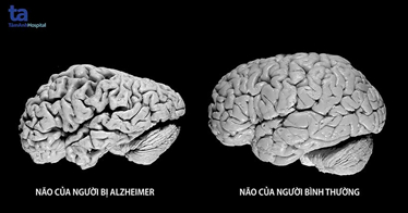 Thảo dược, tiêu dùng xanh và chiến lược chống lão hóa thần kinh (bệnh Alzheimer ) ở người cao tuổi