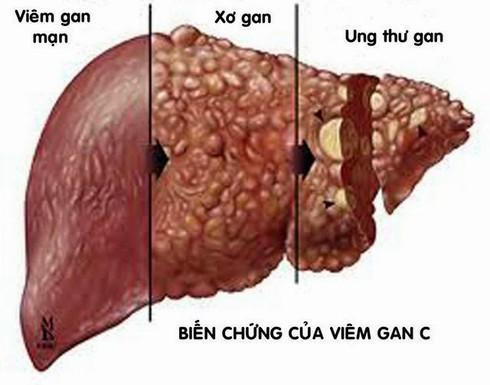 30 triệu người Việt mắc bệnh gan nhiễm mỡ