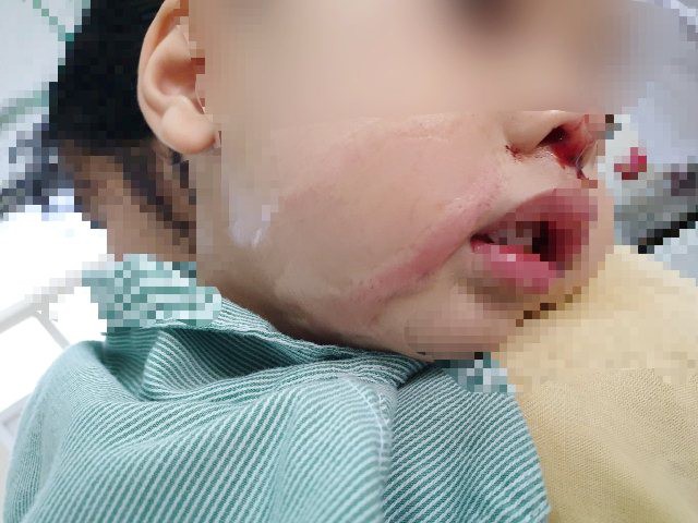 Bé trai 2 tuổi bị nhỏ nhầm axit vào mũi
