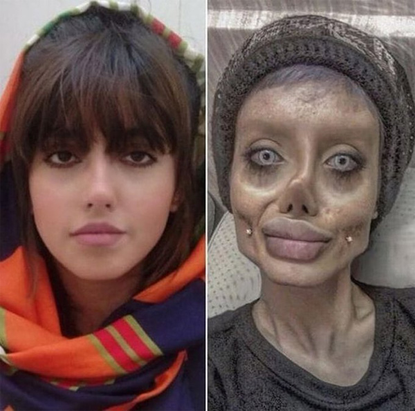 Khuôn mặt Tabar lúc trước (trái) và sau khi phẫu thuật thẩm mỹ. 