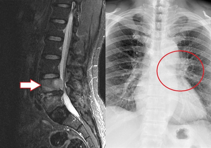   Ung thư phổi đã di căn và “ăn mòn” nhiều đốt sống ở thắt lưng (Ảnh bệnh viện cung cấp)  
