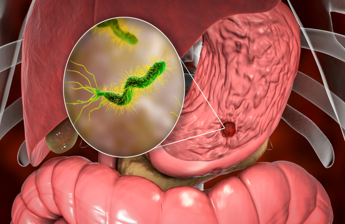   Vi khuẩn HP có thể gây ra viêm loét, ung thư dạ dày (Ảnh minh họa)  