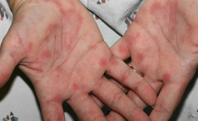   “Bàn tay son” là 1 trong những triệu chứng phổ biến của bệnh về gan (Ảnh minh họa)  
