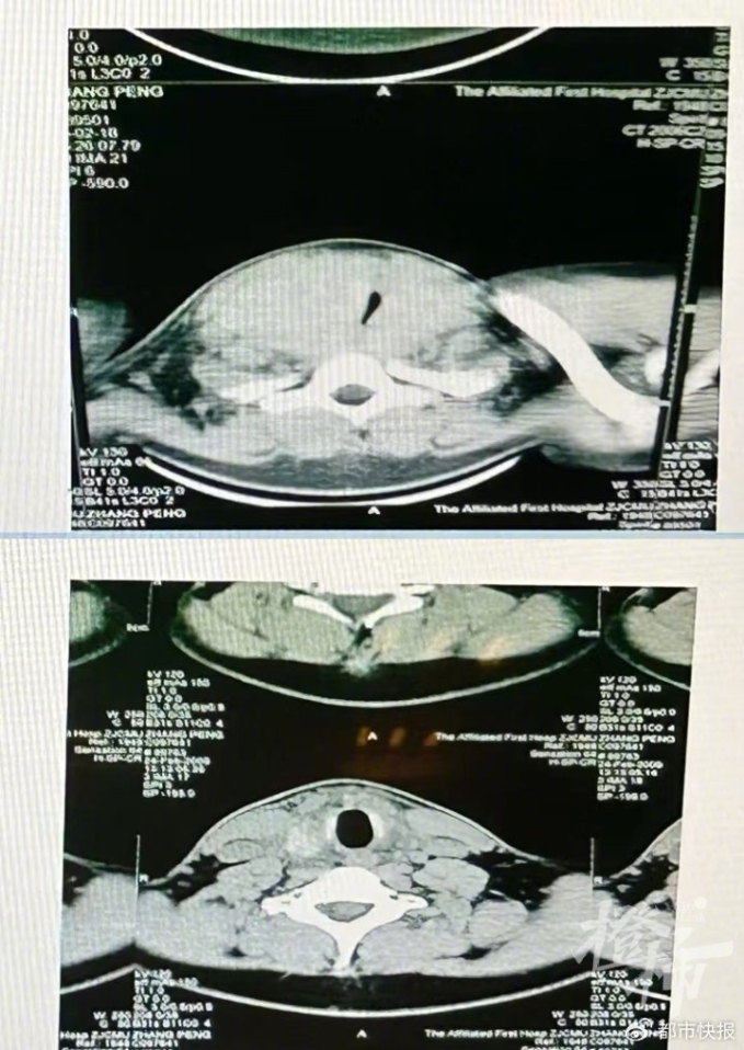 Hình ảnh đường thở của Tiểu Vũ trước và sau khi phẫu thuật (Hình ảnh bệnh viện cung cấp)