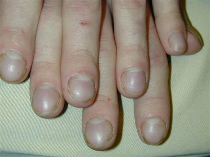   Ngón tay dùi trống là dấu hiệu phổ biến ở người ung thư phổi (Ảnh minh họa)  