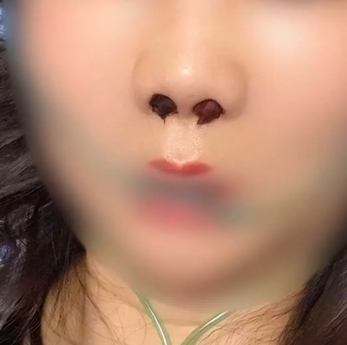 Mũi của cô Bàn sau khi phẫu thuật