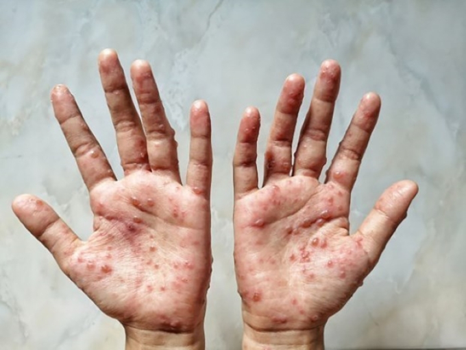 Triệu chứng đặc hiệu của bệnh đậu mùa khỉ là nổi hạch, phát ban, tổn thương trên da (Ảnh minh họa)