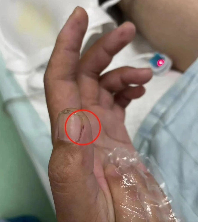 Bệnh nhân có vết thương ở ngón tay cái bên trái.