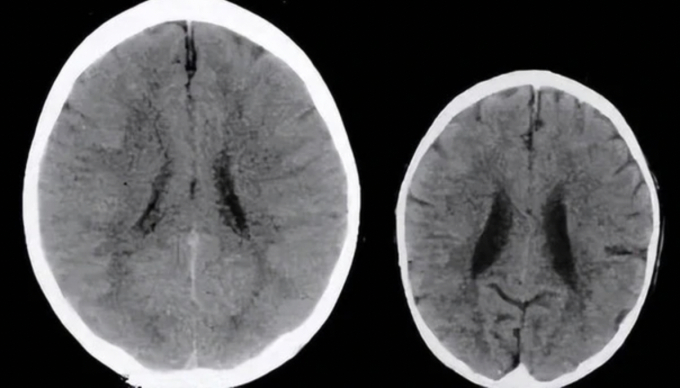 Kết quả nghiên cứu cho thấy trẻ hay bị phụ huynh la mắng (bên phải) có não bộ nhỏ hơn rất nhiều so với các bạn đồng trang lứa