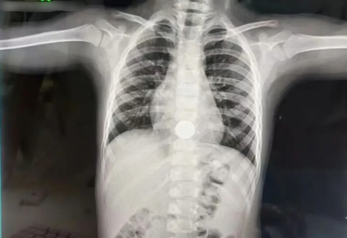 Kết quả chụp xét nghiệm X-quang cho thấy đứa trẻ 3 tuổi đã nuốt đồng xu