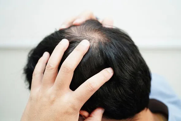 Rụng lông tóc ở ba vùng trên cơ thể có thể là dấu hiệu của bệnh truyền nhiễm