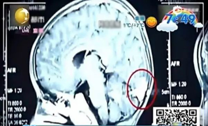   Cậu bé 6 tuổi bị ký sinh trùng ăn rỗng nhiều lỗ ở não bộ, phổi do ăn cua sống (Ảnh bác sĩ cung cấp)  
