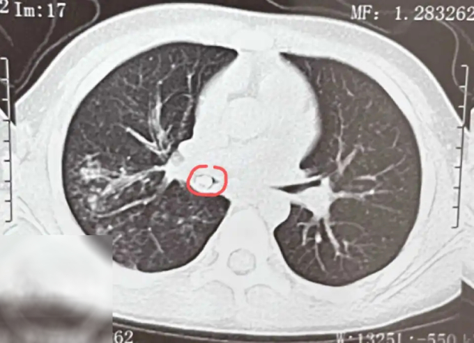 Cậu bé liên tục ho sốt, bác sĩ chụp CT phổi thấy thứ không ai ngờ tới