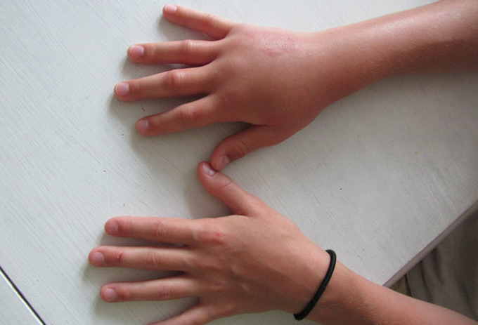   Vị trí gây phù nề nhiều nhất bởi bệnh tuyến giáp là bàn tay, vùng cổ và mí mắt (Ảnh minh họa)  