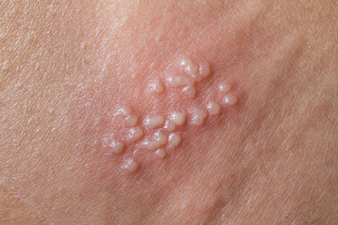   Mụn cóc li ti ở cổ, tay, vùng kín là dấu hiệu nhiễm virus HPV dễ bị nhầm lẫn hoặc xem nhẹ (Ảnh minh họa)  