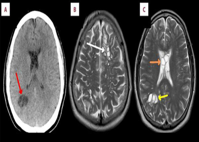   Hình ảnh X-quang cho thấy sán dây lợn đã ký sinh và đẻ trứng trong não người đàn ông (Ảnh BV cung cấp)  
