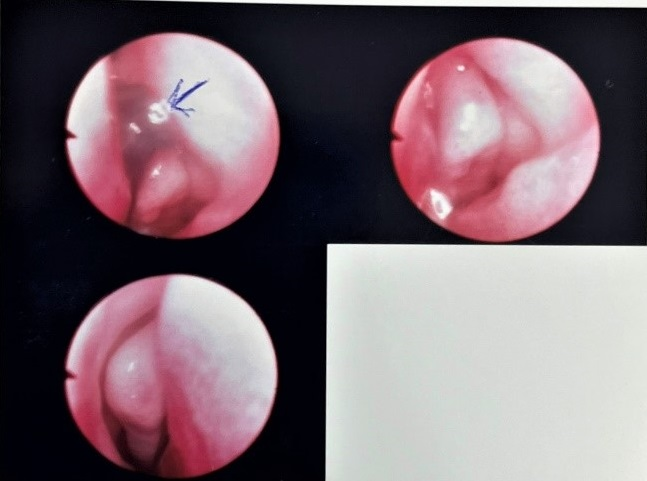 Hình ảnh nội soi cho thấy vị trí của con vắt trong hốc mũi