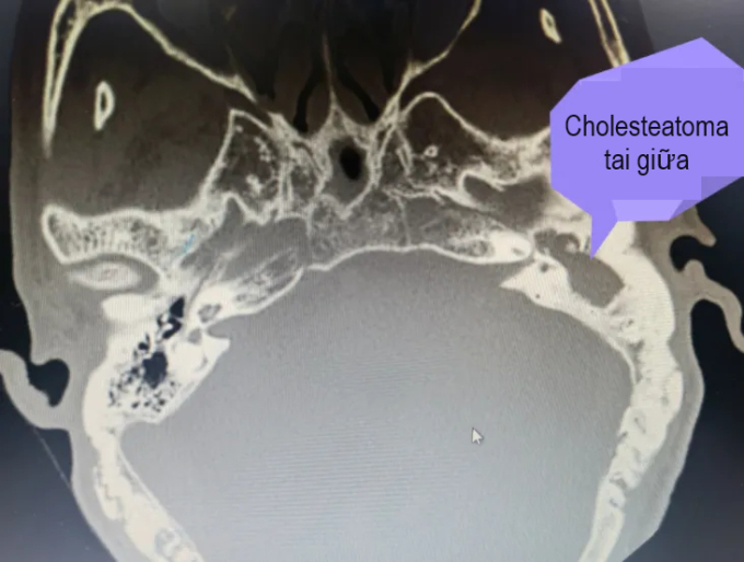 Hình ảnh chụp cholesteatoma tai giữa của ông Wang