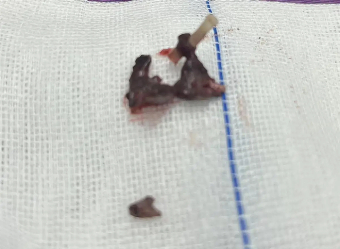   Những viên sỏi mũi được lấy ra sau phẫu thuật của bệnh nhân (Ảnh do Bệnh viện Puren Vũ Hán cung cấp)  