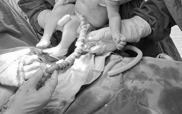 Kíp phẫu thuật đã khẩn trương mổ lấy thai nhanh chóng giúp cháu bé chào đời an toàn (Ảnh: Trung tâm Y tế huyện Phù Ninh)