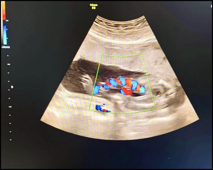 Sản phụ 20 tuổi chuyển dạ, bác sĩ siêu âm giật mình trước hình ảnh bất thường của dây rốn: Mổ lấy thai khẩn cấp!