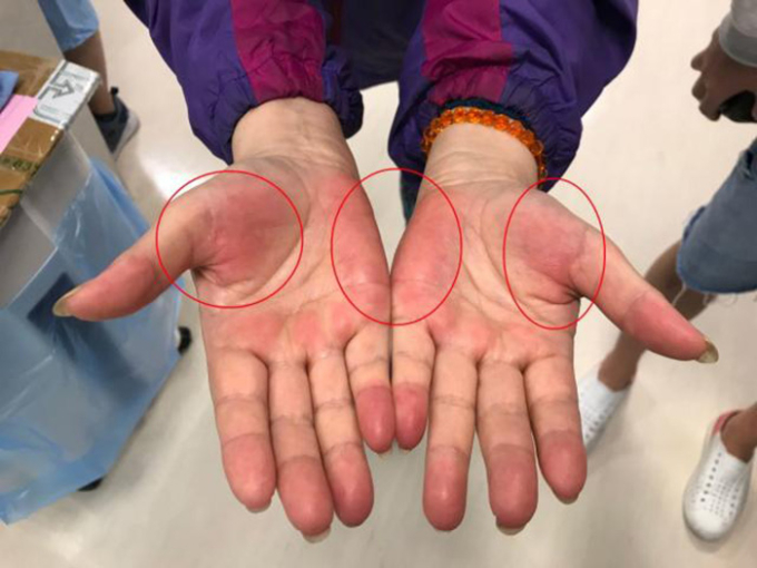   Lòng bàn tay đỏ là một trong những dấu hiệu sớm nhưng dễ bị bỏ qua của bệnh gan (Ảnh minh họa)  