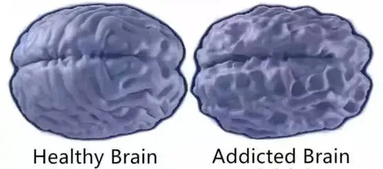 Bên trái là não của trẻ không dùng điện thoại, bên phải là não trẻ nghiện điện thoại
