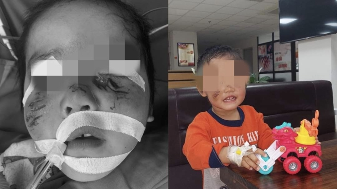 Bé trai 3 tuổi bị rách mặt do chó cắn - Ảnh: Bệnh viện Sản nhi Phú Thọ