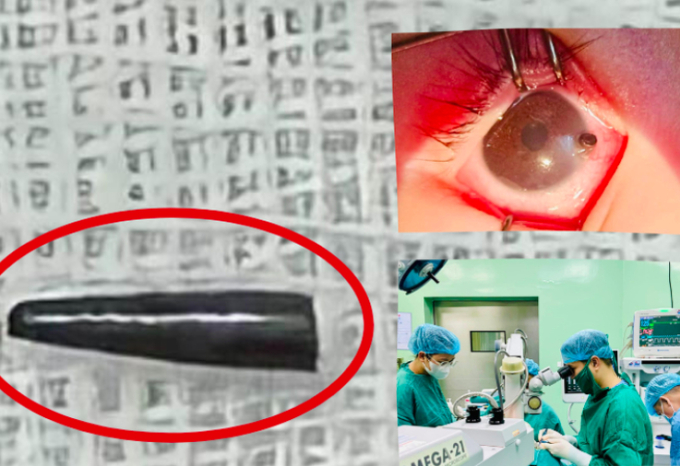 Dị vật được lấy ra là đầu bút chì dài gần 1cm, đường kính 0.5mm. Sau ca phẫu thuật, sức khỏe bệnh nhi ổn định và dự kiến 7-10 ngày được ra viện.