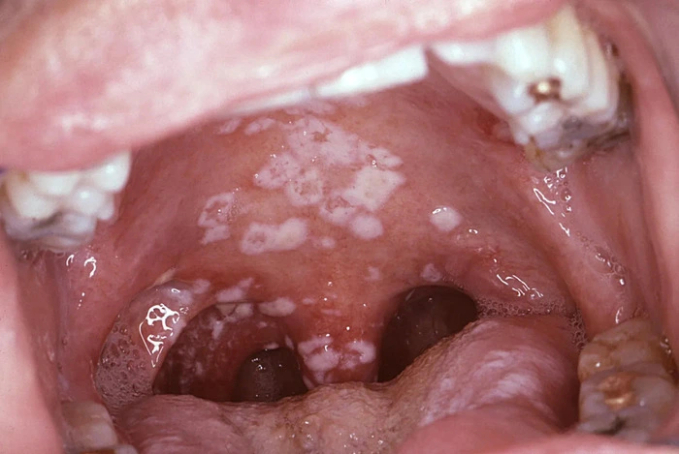   Khoang miệng người phụ nữ “nở hoa” trắng xóa vì nhiễm nấm Candida (Ảnh minh họa)  