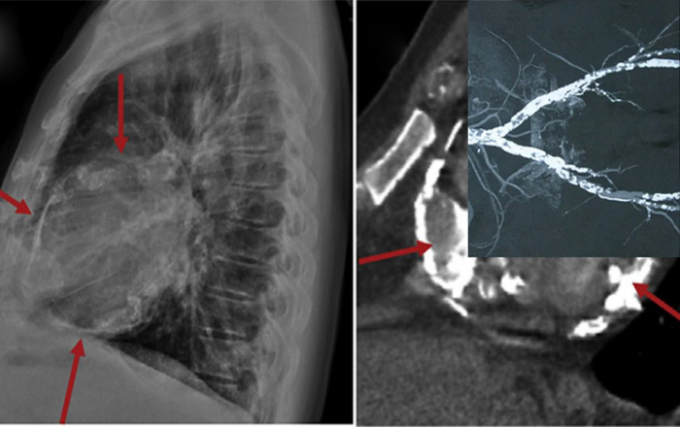   Vôi hóa mạch máu ở tim có thể được phát hiện thông qua chụp X-quang, cộng hưởng từ (Ảnh minh họa)  