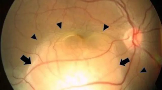 Hình ảnh mắt phải của bệnh nhân, cho thấy tổn thương ung thư và bong võng mạc