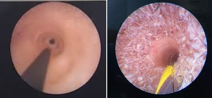   Hình ảnh hẹp niệu đạo của bệnh nhân, hẹp niệu đạo mức độ nặng (trái) và hình ảnh niệu đạo sau khi đặt stent (phải)  