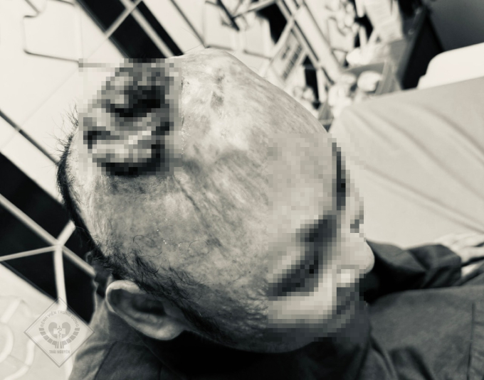 Vết loét trên đỉnh đầu người bệnh N trước khi phẫu thuật