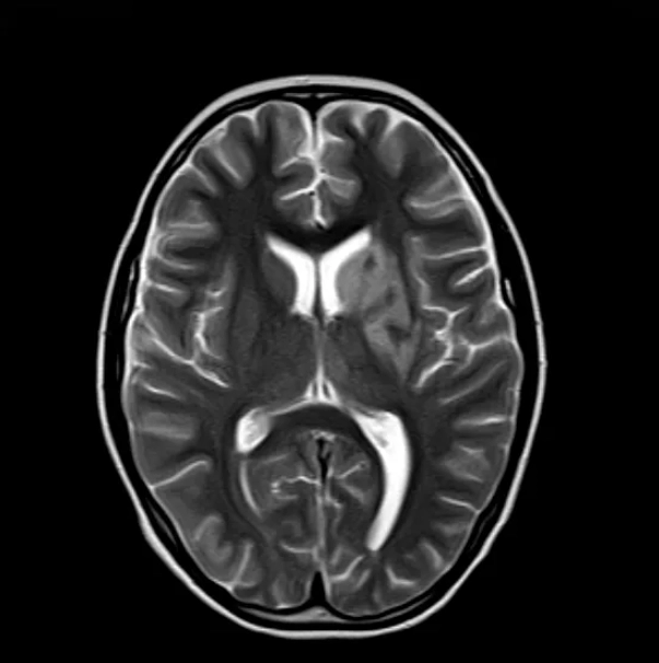   MRI trước khi điều trị của Tiếu Tiếu  