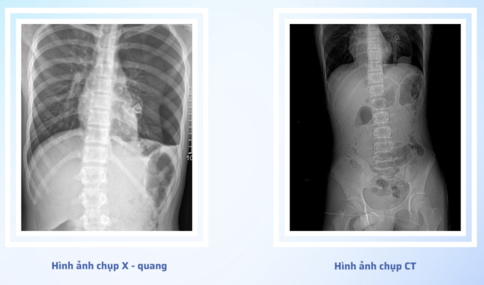 5 giờ phẫu thuật cho thiếu niên 15 tuổi bị cành cây đâm xuyên vùng hậu môn khi nhảy xuống ao tắm