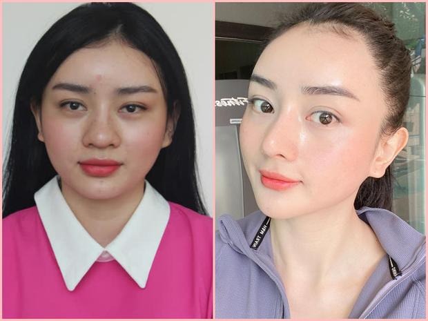 Angela Chu trước và sau khi phẫu thuật