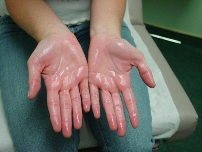  Ngoài chứng tăng tiết mồ hôi tay, đổ mồ hôi quá nhiều ở lòng bàn tay còn có thể do gan, thận gặp vấn đề (Ảnh minh họa)  