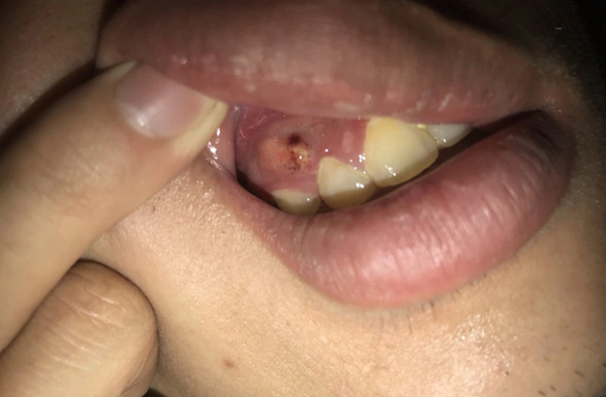  Vết loét ở nướu hay lưỡi, niêm mạc miệng quá 2 tuần không khỏi đều có thể là khối u ác tính (Ảnh minh họa)  