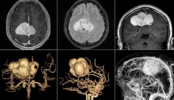   Hình ảnh khối u não khổng lồ của bệnh nhân được phát hiện nhờ dấu hiệu tê tay trái (Ảnh BV cung cấp)  