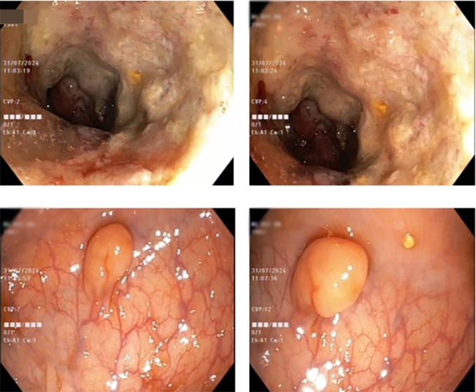 Hình ảnh nội soi đại tràng của bệnh nhân H. 