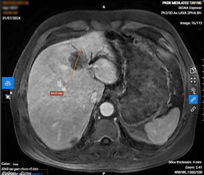 Hình ảnh khối u tại gan của bệnh nhân