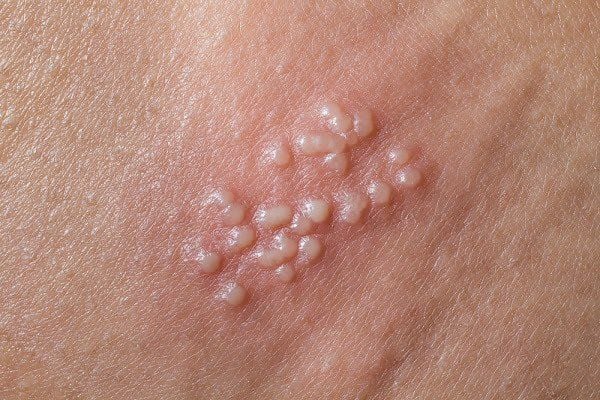 Đọc ngay bài viết để “bệnh khó nói” này không trở thành “cơn ác mộng