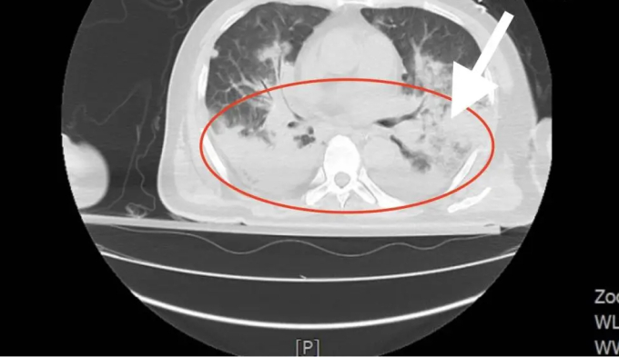 Ảnh chụp CT cho thấy một nửa phổi của ông Cương bị nấm Aspergillus 