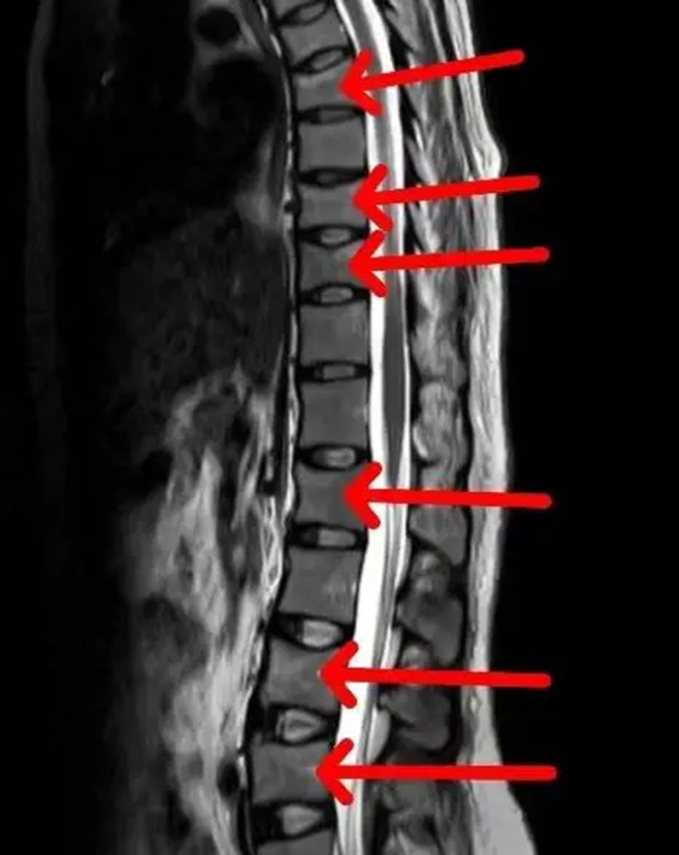 Người phụ nữ 27 tuổi bị gãy nhiều đốt xương do loãng xương sớm sau sinh nở (Ảnh BV cung cấp)